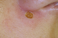 Die Pigmentflecke vom chemischen Peeling